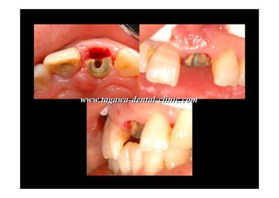 早期埋入の術前術後イメージ例2（田川歯科）